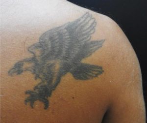 Tattoo vor der Behandlung